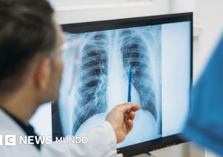 Qué es un adenocarcinoma pulmonar, el tipo de tumor maligno que le extirparon al papa León XIV
