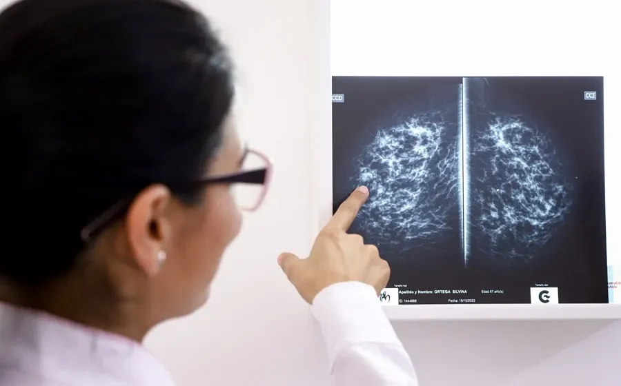 Un fármaco para suprimir la lactancia podría reducir el riesgo de cáncer de mama